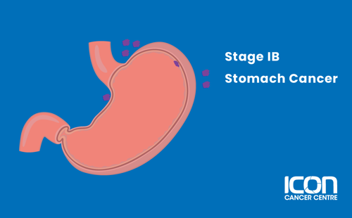Stage IB stomach cancer illustration