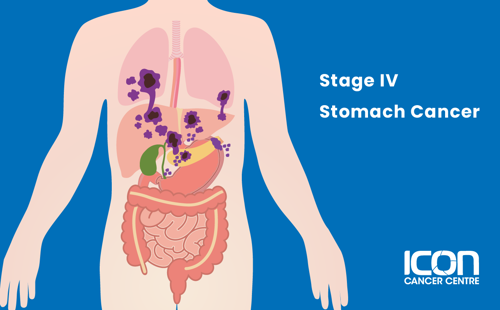 Stage IV stomach cancer illustration