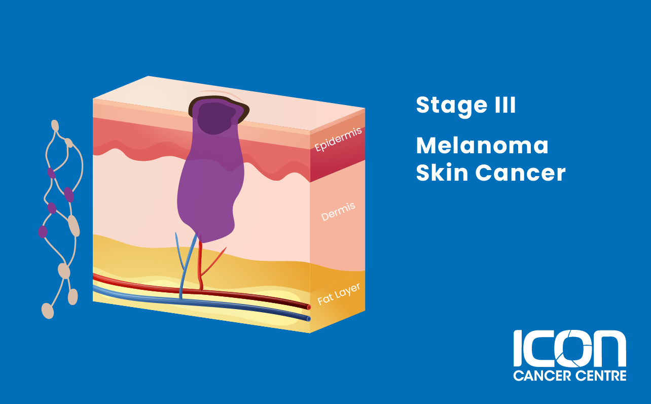 Stage III melanoma illustration