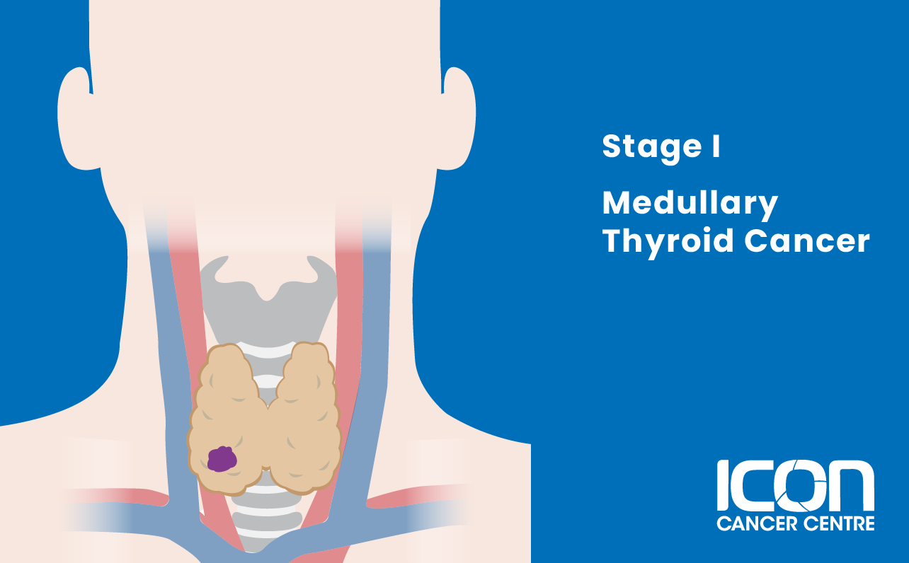 Stage I medullary thyroid cancer illustration