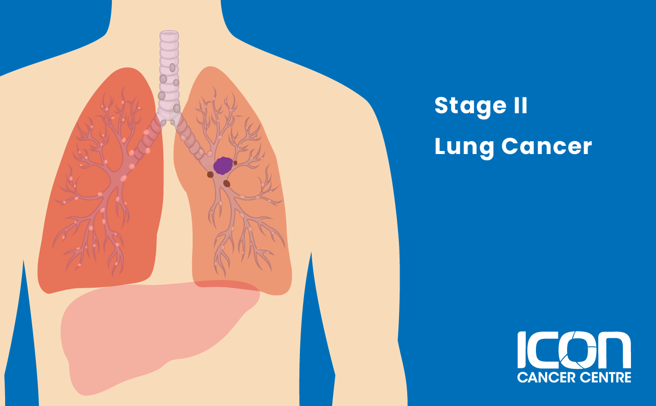 Stage II lung cancer illustration