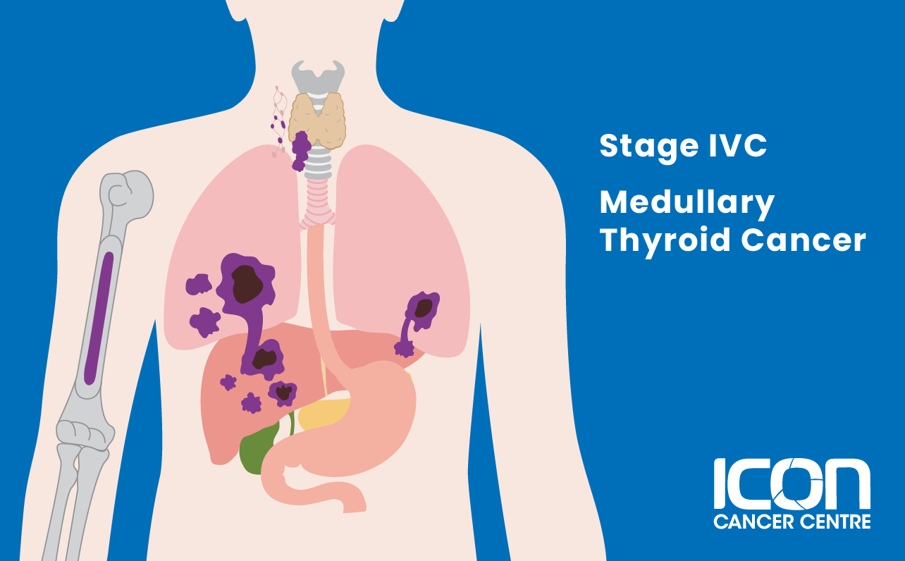 Stage IVC medullary thyroid cancer illustration